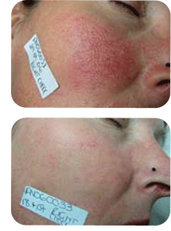 Red Vein Laser Treatment Before and After