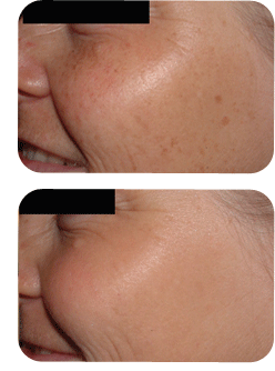 Skin Rejuvenation Laser Treatment After